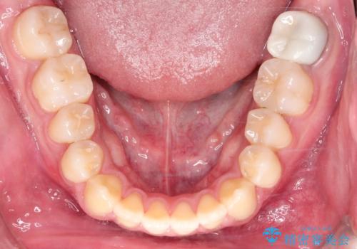 【ワイヤー矯正】前歯の凸凹を治したい。の治療後