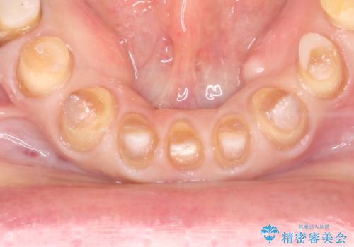 【オールセラミッククラウン】ダイレクトボンディングからのやりかえの治療中