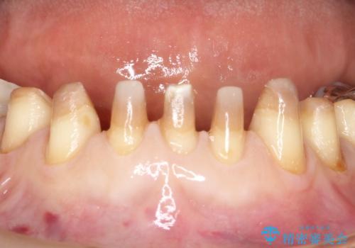 【オールセラミッククラウン】ダイレクトボンディングからのやりかえの治療中