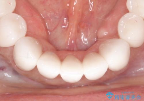 【オールセラミッククラウン】ダイレクトボンディングからのやりかえの治療後