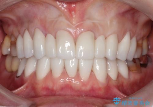 【オールセラミッククラウン】前歯を綺麗にしたい。の症例 治療後