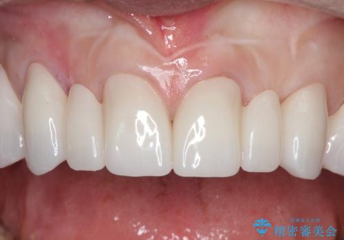 【オールセラミッククラウン】前歯を綺麗にしたい。の治療後