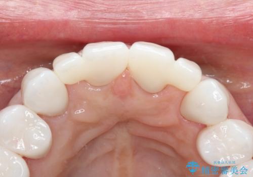 【オールセラミッククラウン】前歯を綺麗にしたい。の治療後