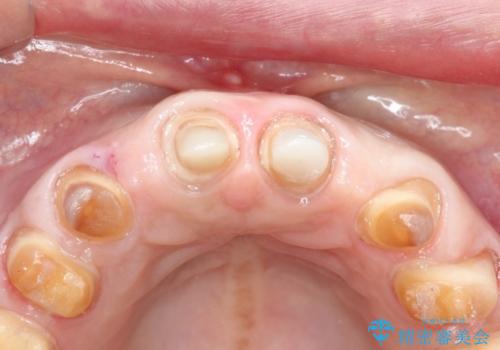 【オールセラミッククラウン】前歯を綺麗にしたい。の治療中