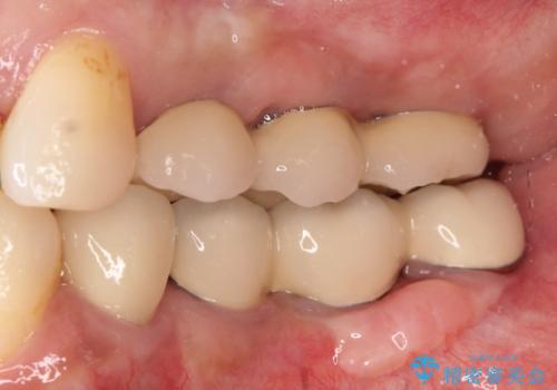 【インプラント】奥歯に歯を入れたいの治療後