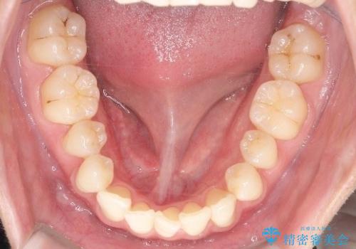 前歯の重なりとガタガタをマウスピースで改善した症例の治療前