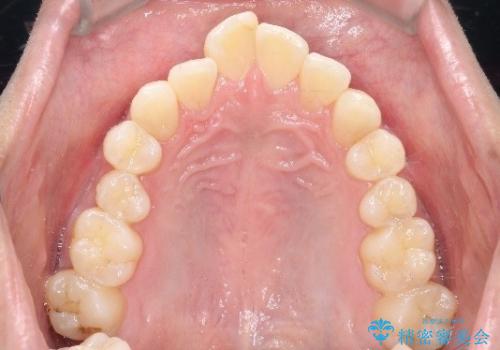 前歯の重なりとガタガタをマウスピースで改善した症例の治療前