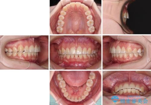 【モニター】前歯のデコボコを目立たないワイヤー装置で短期間矯正治療の治療後