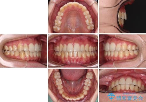 【モニター】前歯の前突感とクロスバイトをインビザラインで改善の治療後
