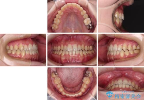 オープンバイトと前歯のデコボコをインビザライン矯正で解消の治療後
