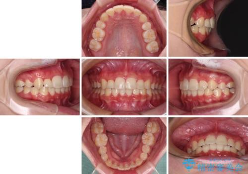インビザラインが続けられない ワイヤー矯正での抜歯矯正 その2の治療後