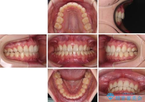 上顎のみの抜歯矯正 前歯のデコボコを改善するの治療後