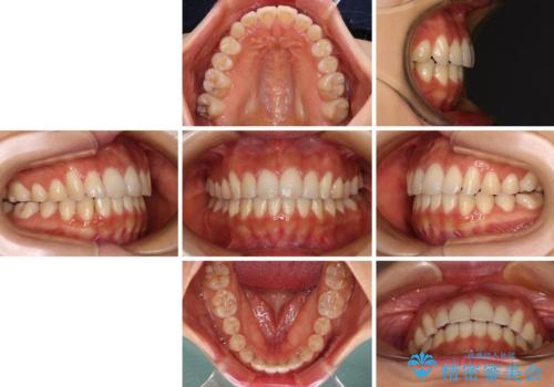 カリエールディスタライザーを併用した、咬み合わせ改善のインビザライン矯正の治療後