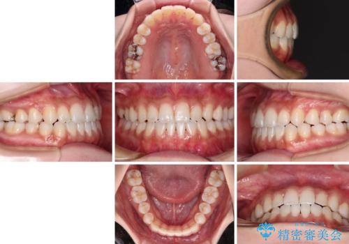 舌突出癖で口元が開いてしまう 舌トレーニングを行ったインビザライン矯正の治療後