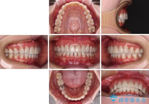 前歯の突出感とデコボコをインビザライン矯正で改善の治療後