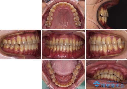 前歯のクロスバイトを改善　ワイヤー装置での非抜歯矯正の治療後