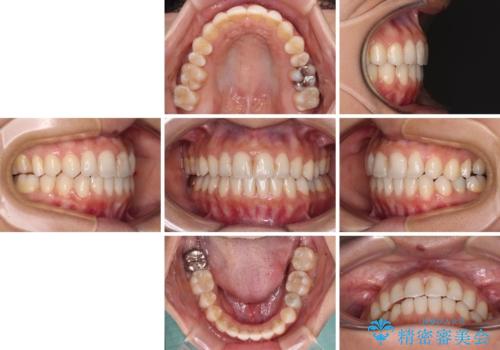 オープンバイトによる見た目を治したい インビザラインでの矯正治療の治療後