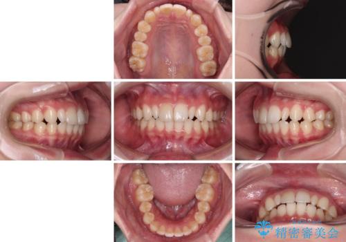 【モニター】ワイヤー矯正で手っ取り早く治療の治療後