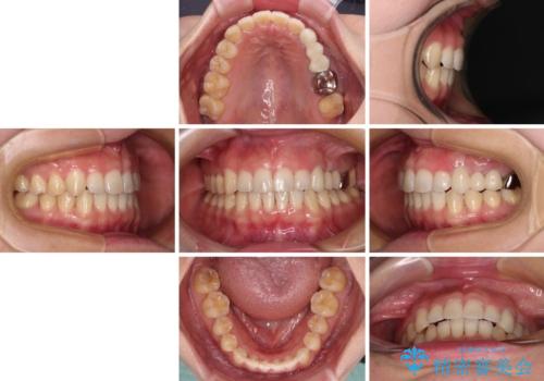 捻れた前歯と銀歯のブリッジを治したい ワイヤー矯正とオールセラミックブリッジの治療後