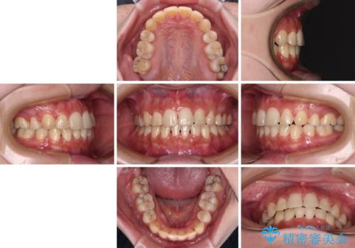 インビザラインが続けられない　ワイヤー矯正での抜歯矯正　その1の治療後