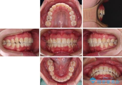 【モニター】八重歯を抜歯矯正でスッキリした口元にの治療後