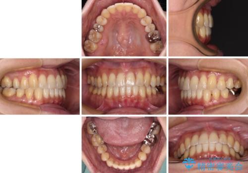 リスク回避 ワイヤー矯正を併用したインビザライン矯正治療の治療後