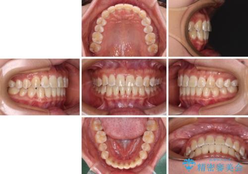 前歯の隙間と上下正中のズレを解消の治療後