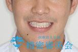 前歯の重なりとガタガタをマウスピースで改善した症例の治療前（顔貌）