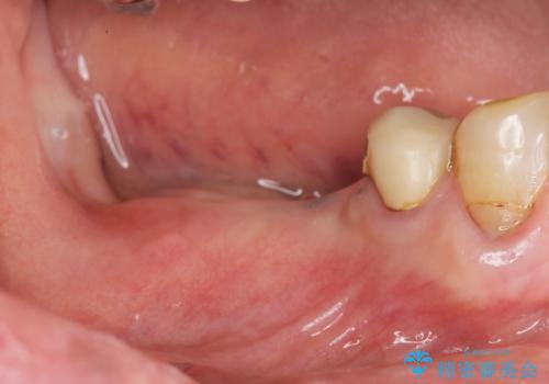 [ ノンクラスプデンチャー ]  目立たない入れ歯の作製の症例 治療前