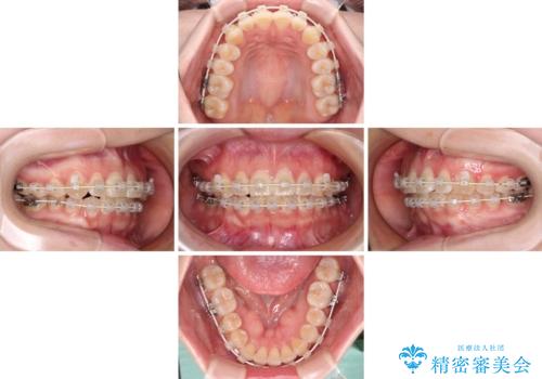 【モニター】前歯のデコボコを目立たないワイヤー装置で短期間矯正治療の治療中