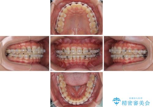 前歯の隙間と上下正中のズレを解消の治療中