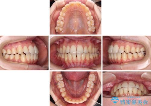 【モニター】前歯の前突感とクロスバイトをインビザラインで改善の治療中