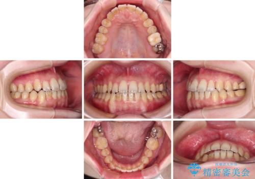 オープンバイトと前歯のデコボコをインビザライン矯正で解消の治療中