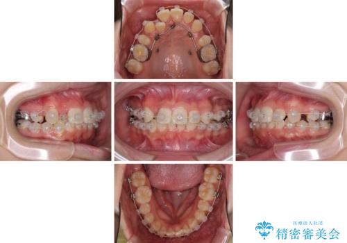 インビザラインが続けられない ワイヤー矯正での抜歯矯正 その2の治療中