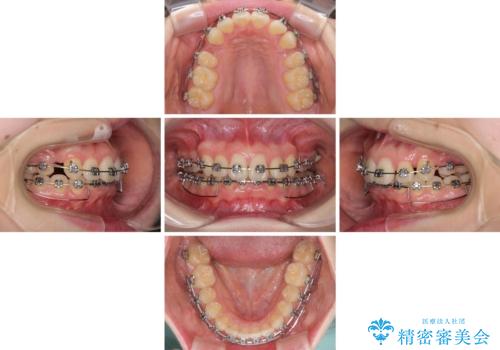 上顎のみの抜歯矯正 前歯のデコボコを改善するの治療中