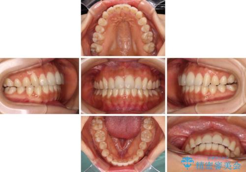 カリエールディスタライザーを併用した、咬み合わせ改善のインビザライン矯正の治療中