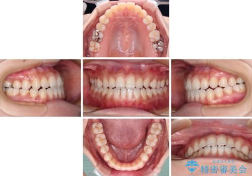 舌突出癖で口元が開いてしまう 舌トレーニングを行ったインビザライン矯正の治療中