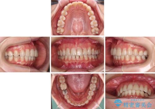 前歯の突出感とデコボコをインビザライン矯正で改善の治療中