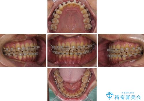 前歯のクロスバイトを改善　ワイヤー装置での非抜歯矯正の治療中