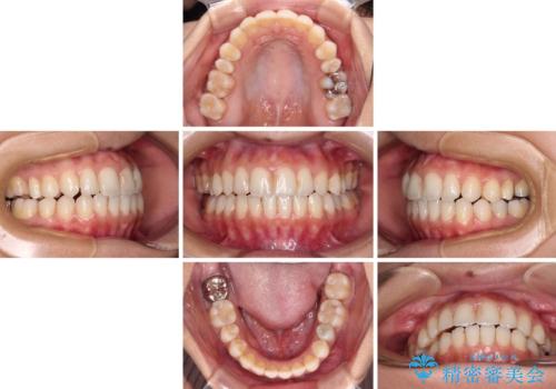 オープンバイトによる見た目を治したい インビザラインでの矯正治療の治療中