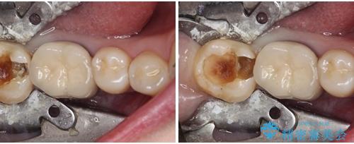 奥歯に物が挟まる　セラミックインレーによる虫歯治療の治療中