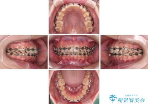 【モニター】ワイヤー矯正で手っ取り早く治療の治療中