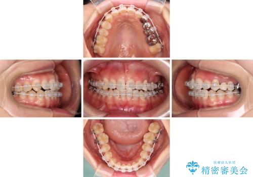 捻れた前歯と銀歯のブリッジを治したい ワイヤー矯正とオールセラミックブリッジの治療中