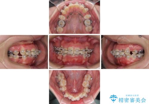 【モニター】八重歯を抜歯矯正でスッキリした口元にの治療中