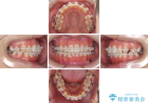 インビザラインが続けられない　ワイヤー矯正での抜歯矯正　その1の治療中