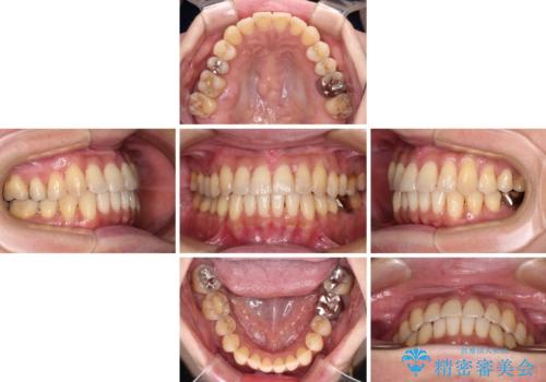 リスク回避 ワイヤー矯正を併用したインビザライン矯正治療の治療中