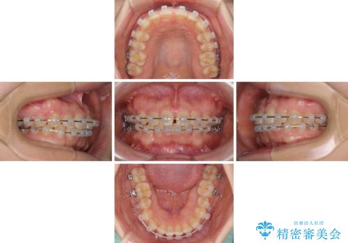 【モニター】前歯の歯列不正をワイヤー装置で短期間矯正治療の治療中