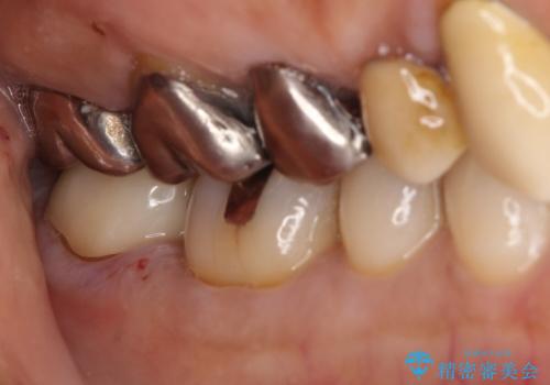 【フルジルコニアクラウン】他院で治療したクラウンが外れたの治療後