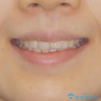 カリエールディスタライザーを併用した、咬み合わせ改善のインビザライン矯正の治療前(顔貌)