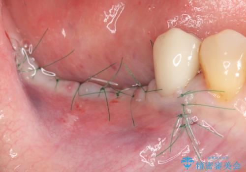 骨の造成を同時に行うインプラント治療の治療前